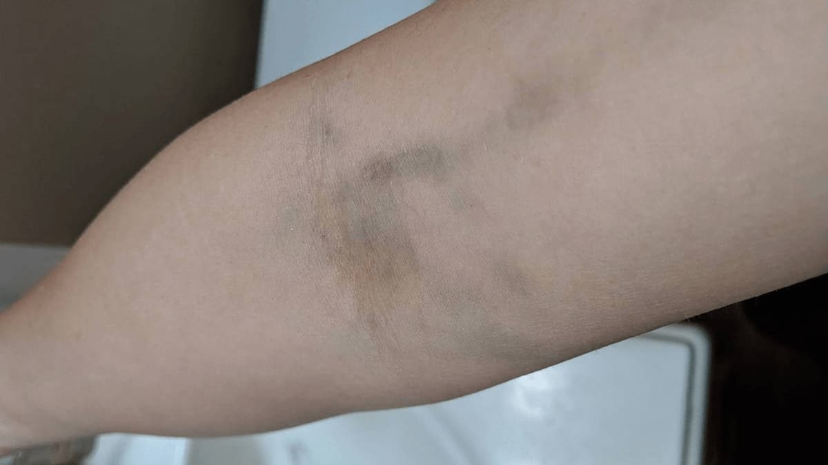 علت کبودی دست بعد از خون دادن 1