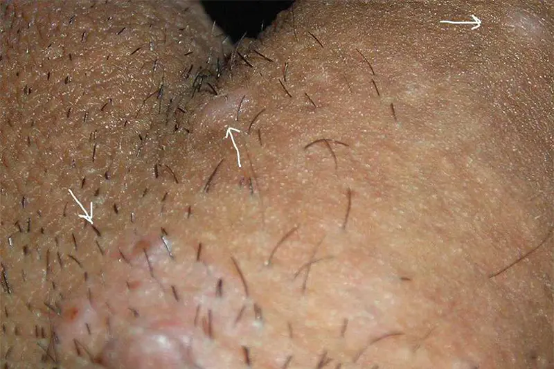 انجام تست HPV مردان