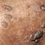 آزمایش HPV در مردان