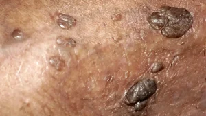 آزمایش HPV در مردان