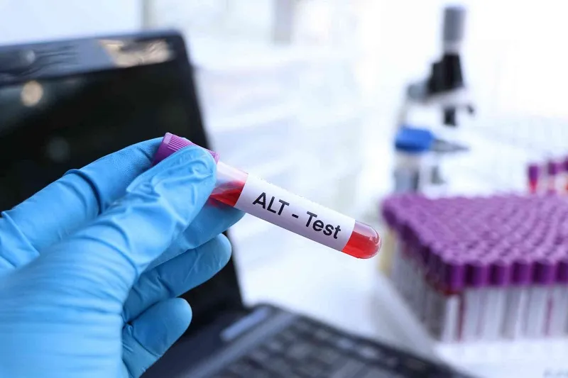 Alt در آزمایش خون 1